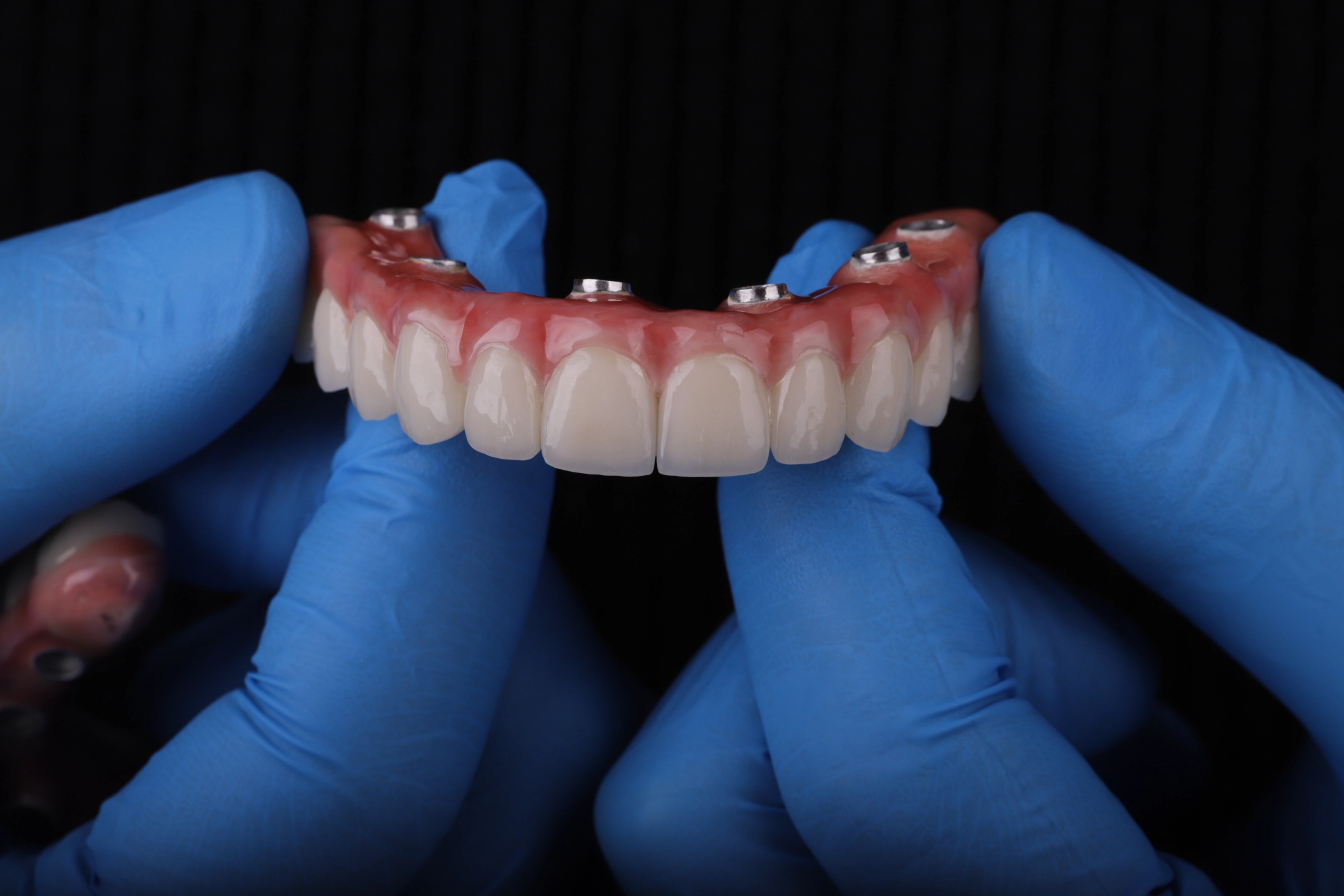 Dinți ficși pe implanturi dentare