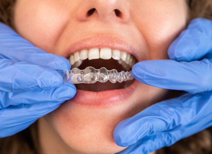 Aparat Dentar Invisalign  – Preț, Tratament, Păreri