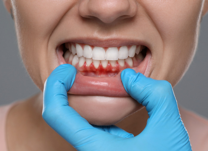 Dinți ficși pe implanturi dentare